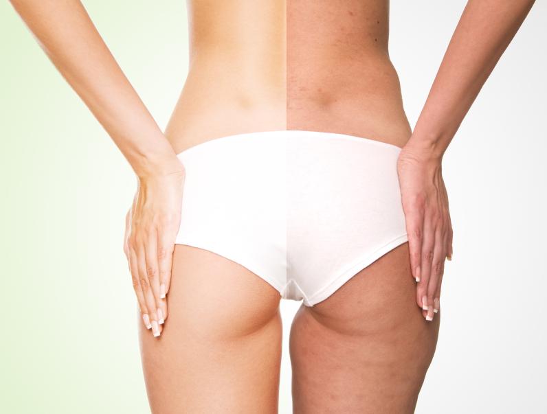 organic-cellulite-treatments